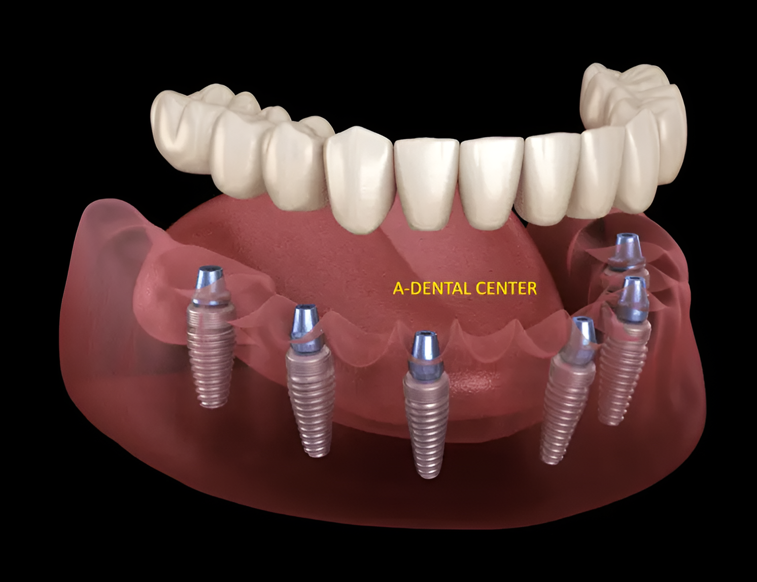 Dentist_In_North_Hollywood_All-on-4_Versus_All-on-6_Hybrid_Dentures__dR604Le