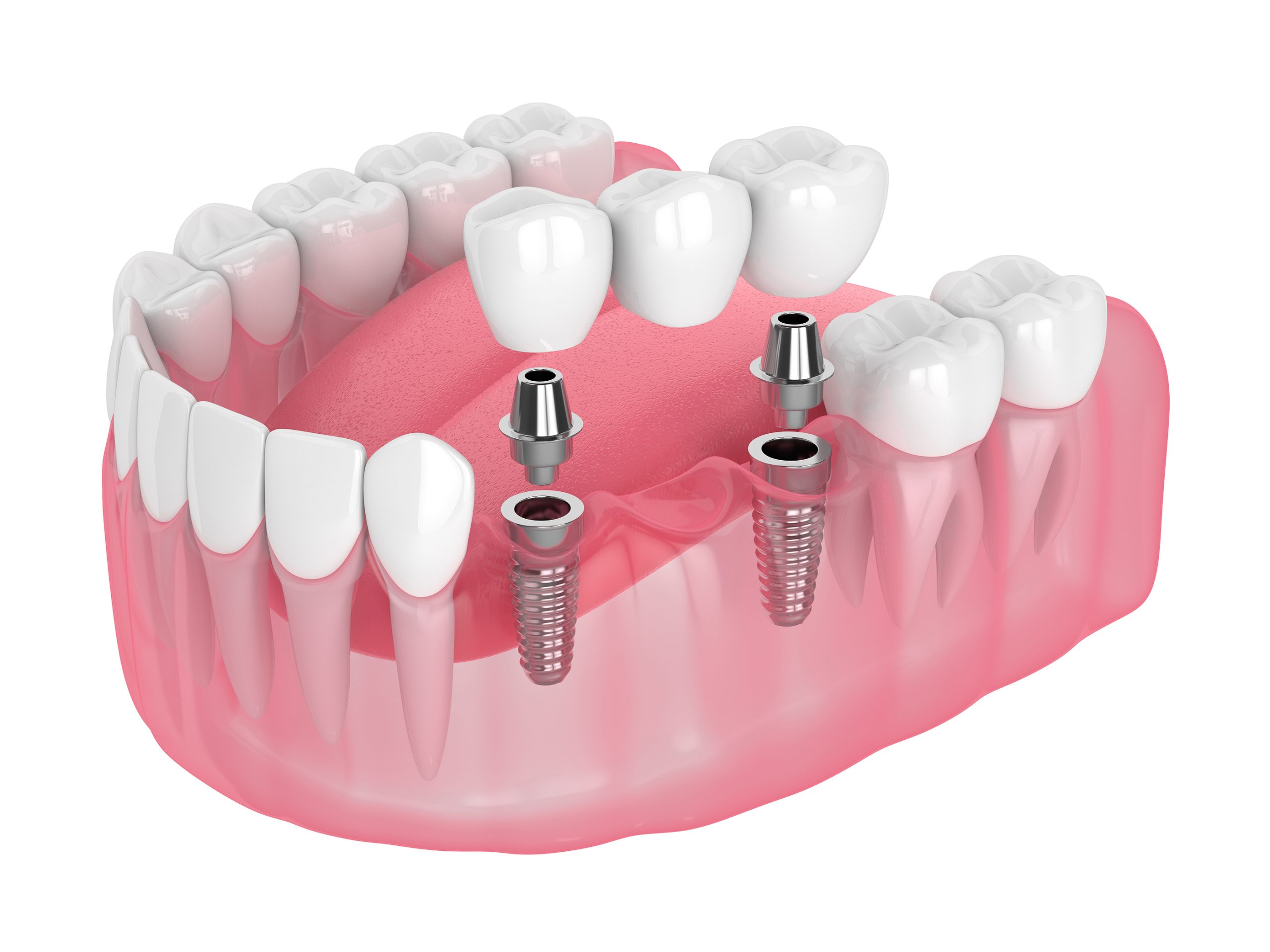 3d Render Of Jaw With Implants Supported Dental Bridge Isolated
