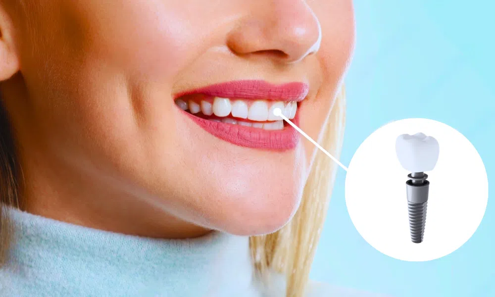 Dentist_In_North_Hollywood_CA_blog-Dental_Implants