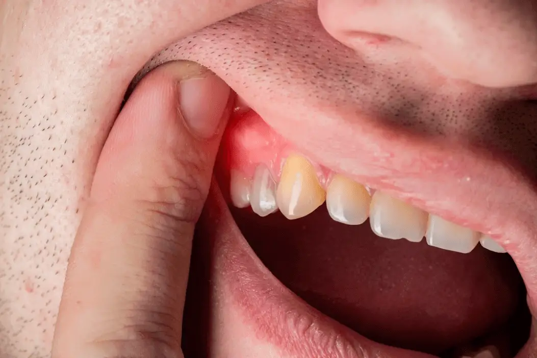 Dentist_In_North_Hollywood_CA_gum-disease