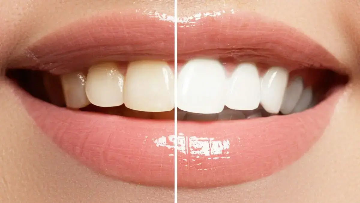 Dentist_In_North_Hollywood_Teeth-whitening