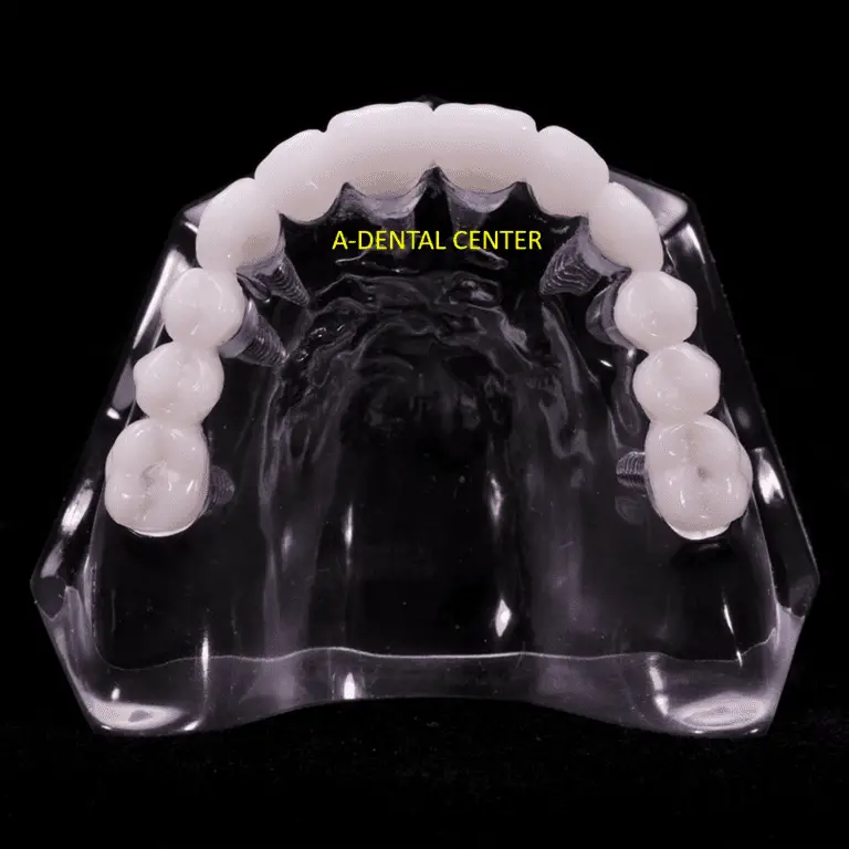 Dentist_In_North_Hollywood_all-on-6-fixed-hybrid-zirconia-bridge_img2_allon4