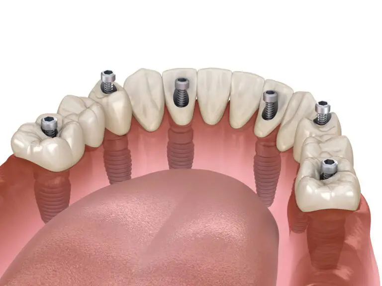 Dentist_In_North_Hollywood_dentist-north-dental_Implant_options_img1__lSS6sUE