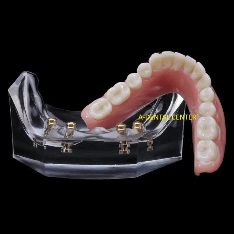 Dentist_In_North_Hollywood_flippers-and-removable-partial-dentures_im_0KKtRyw
