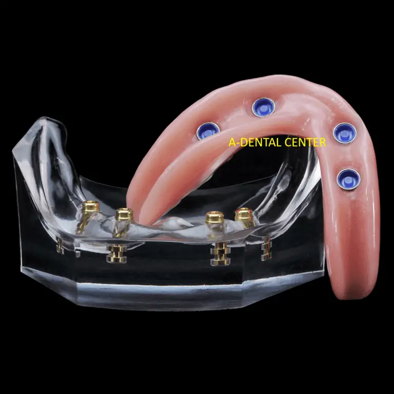 Dentist_In_North_Hollywood_flippers-and-removable-partial-dentures_im_58aCmf0 (1)