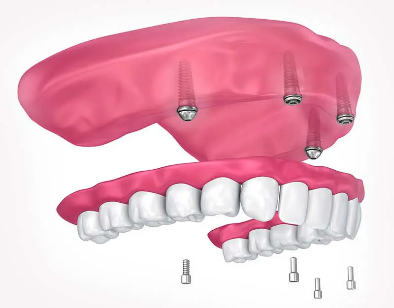 hybrid-dentures-illustrations