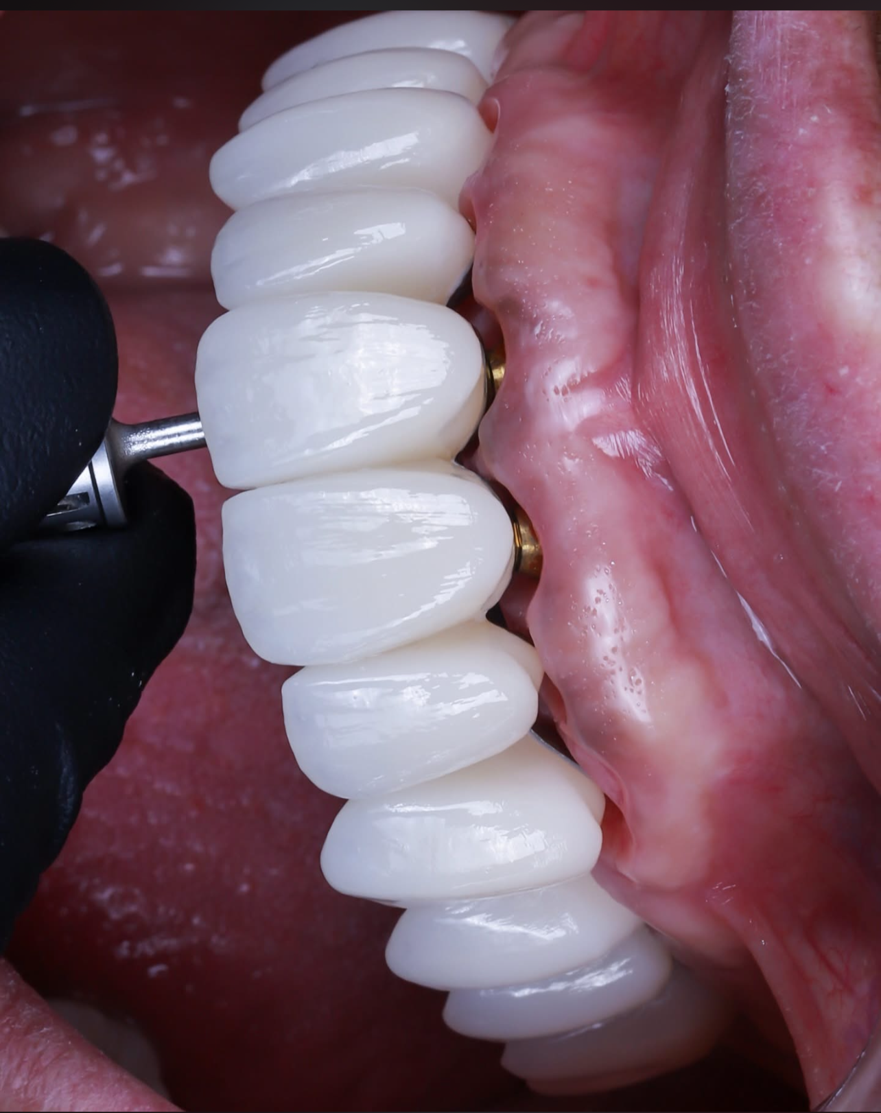 All-on-4 dental implants North Hollywood — full arch fixed teeth A-Dental Center