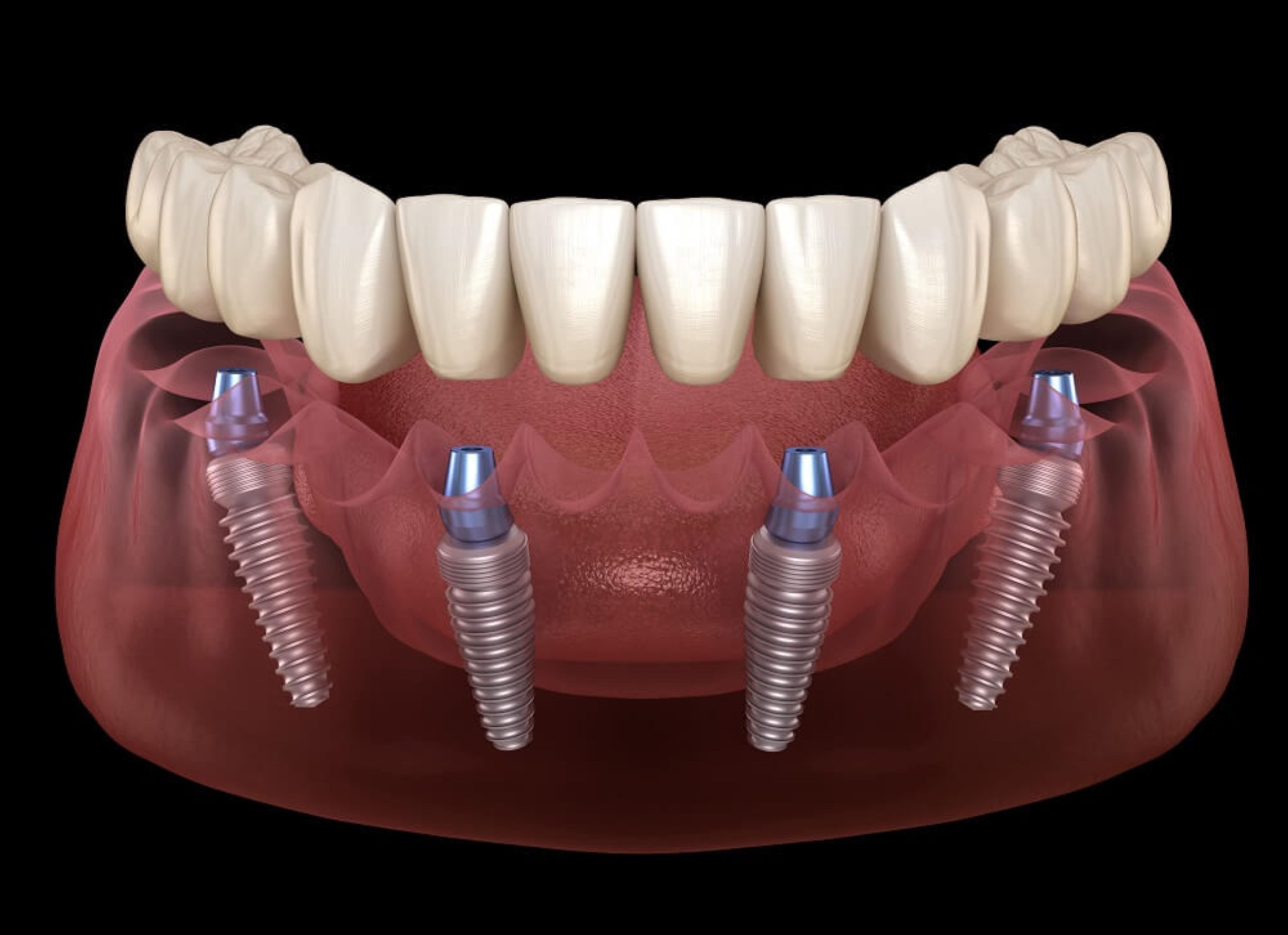 Full mouth restoration bridges and dental implants North Hollywood — A-Dental Center