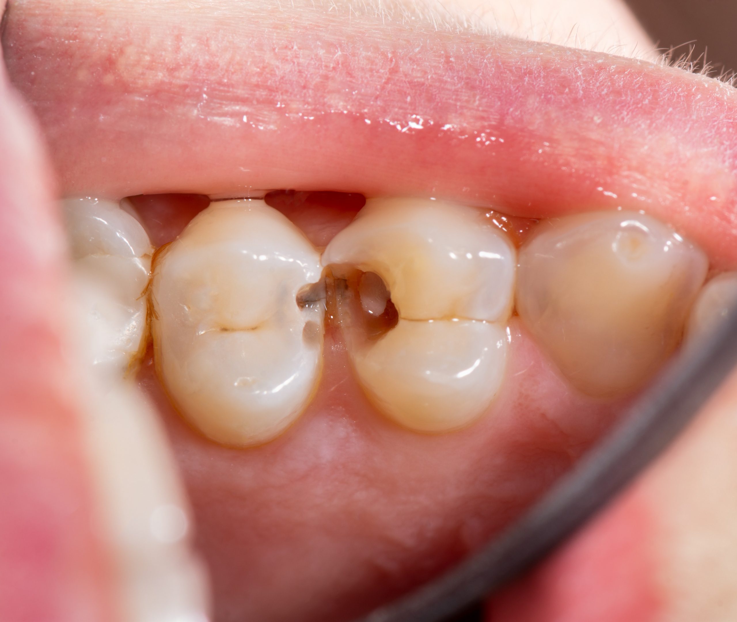 What happens if you don't fill a cavity North Hollywood — decay progression A-Dental Center